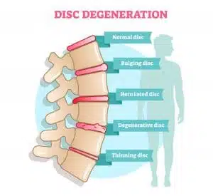 poster of Disc Degenerative poster of Disc Degenerative