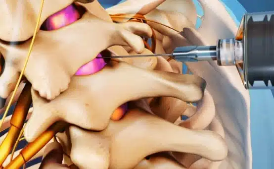 Epidural Steroid Injection medical illustration