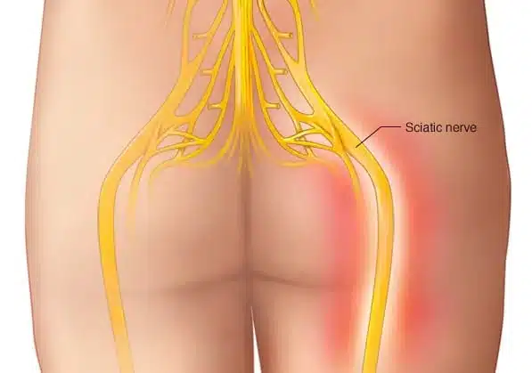 Sciatica nerve medical illustration